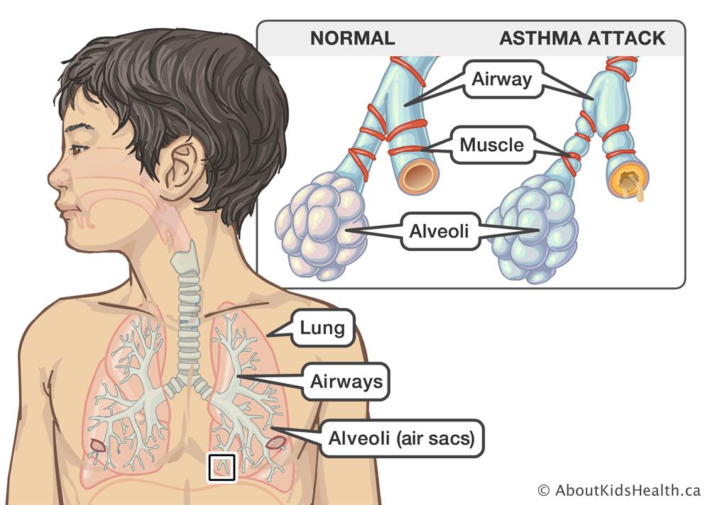 Asthma 1