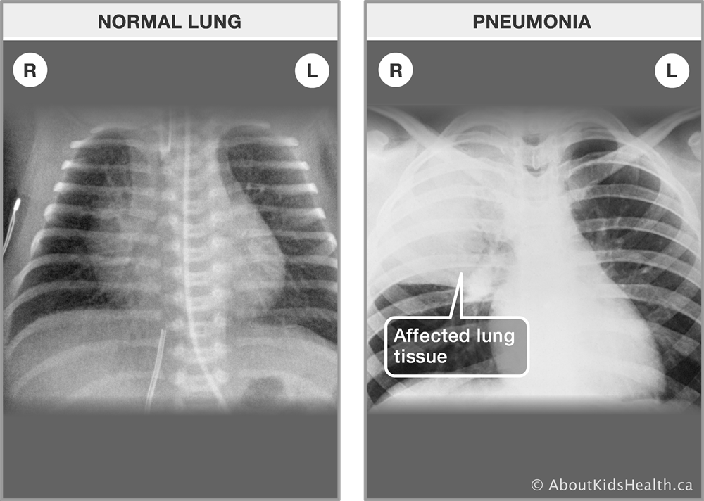 Pneumonia