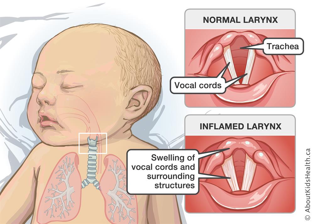 Croup