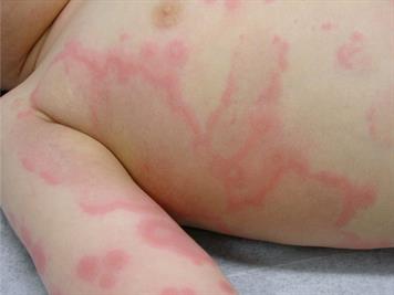 Urticaria Rash